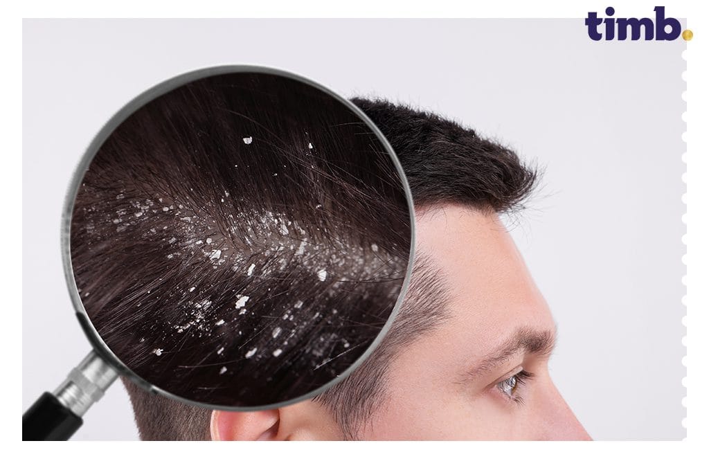 Stress and Dandruff: How Anxiety Affects Your Scalp